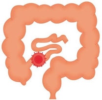 Endständige Ileostomie Endständige Ileostomie