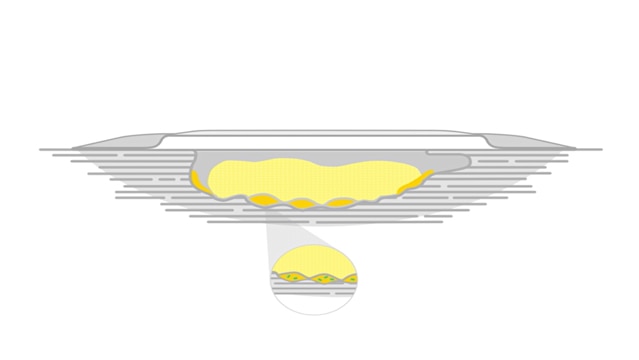 Biatain® Fiber bleibt formstabil während der Anwendung und schrumpft nur minimal. 