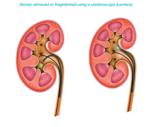 Stones removed or fragmented using a ureteroscope (camera)