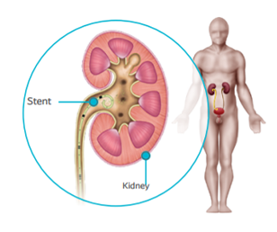 Ureteral Stent in kidney