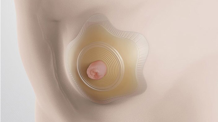 SenSura® Mio Konkav: Für individuelle Rundungen